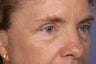 Eyelid Surgery