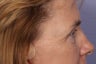 Eyelid Surgery