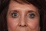 Eyelid Surgery