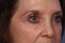 Eyelid Surgery
