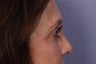Eyelid Surgery