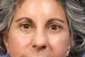 Eyelid Surgery