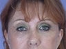 Eyelid Surgery