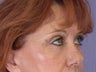 Eyelid Surgery