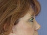Eyelid Surgery