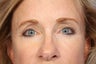 Eyelid Surgery