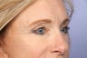 Eyelid Surgery