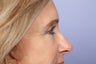 Eyelid Surgery