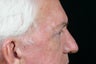 Eyelid Surgery