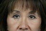 Eyelid Surgery