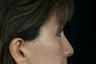 Eyelid Surgery