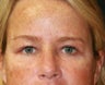 Blepharoplasty