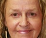 Upper Eyelid Blepharoplasty and Corner of Lip Lift