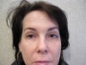 Eyelid Surgery