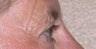 Eyelid Surgery