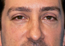 Blepharoplasty