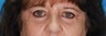 Blepharoplasty (eyelid lift)