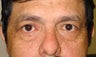 Eyelid Surgery