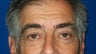 Eyelid Lift- Blepharoplasty
