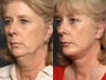 Eyelid surgery