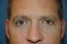 Upper and lower blepharoplasty