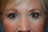 Upper and lower blepharoplasty