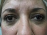 Blepharoplasty