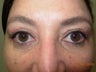 Blepharoplasty