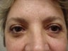 Blepharoplasty