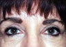 Eyelid Enhancement