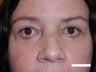 Eyelid Surgery
