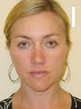 Eyelid Surgery