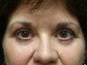 Blepharoplasty