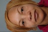 Facial Fat Transfer and Lower Blepharoplasty