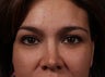 Lower eyelid and cheek rejuvenation