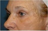 Blepharoplasty