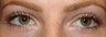 Upper Eyelid Blepharoplasty