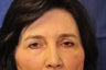 upper/lower blepharoplasty, browlift