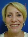 Blepharoplasty