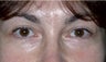Upper and Lower Eyelid Lift 