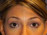 Lower Eyelid Lift