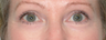 Laser Eyelid Surgery