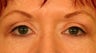 Upper Blepharoplasty (Upper Eyelids)