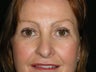 Eyelid Surgery