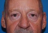 Upper and Lower Eyelid Surgery