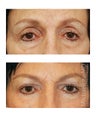 Facial Rejuvenation - Eyelid Surgery