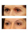 Facial Rejuvenation - Eyelid Surgery