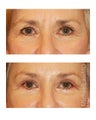 Facial Rejuvenation - Eyelid Surgery