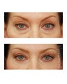 Facial Rejuvenation - Eyelid Surgery