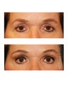 Facial Rejuvenation - Eyelid Surgery